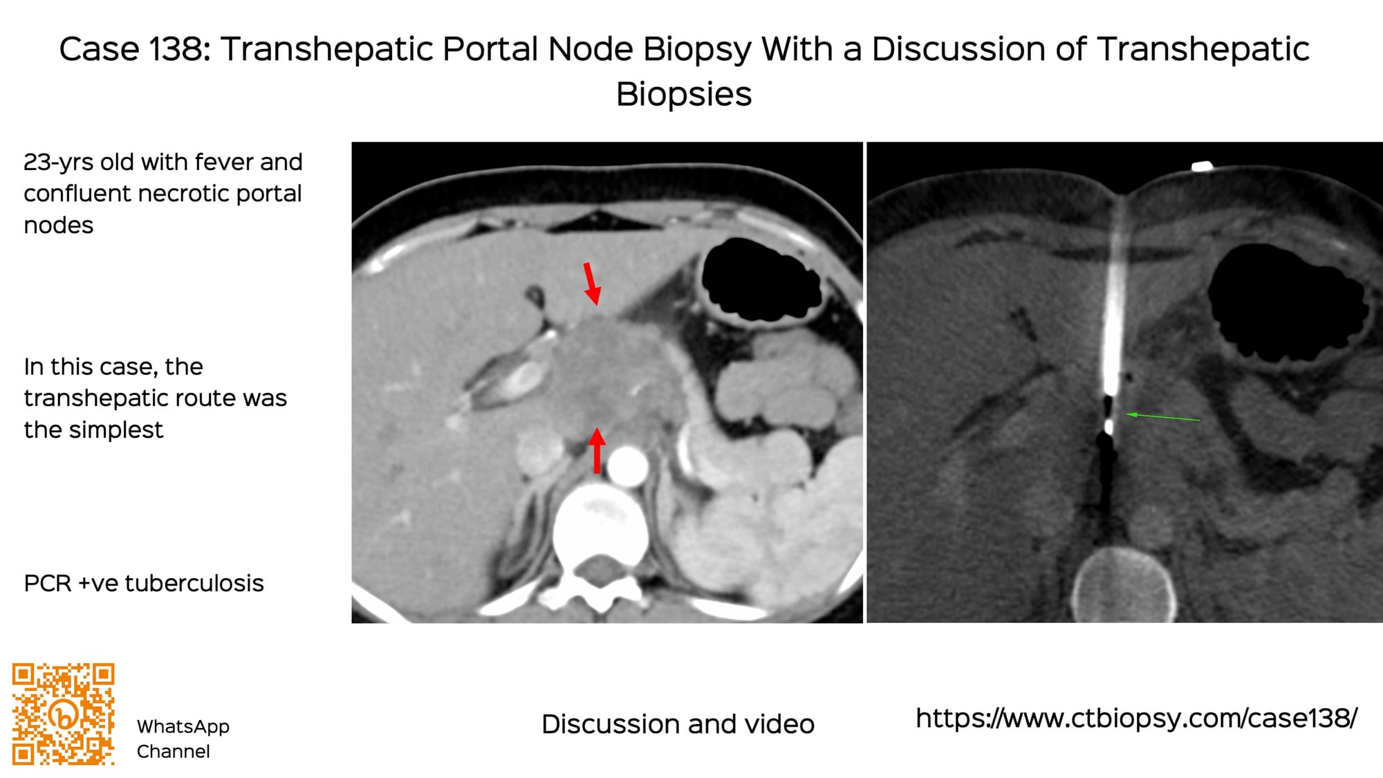 Case 138: Transhepatic Portal Node Biopsy