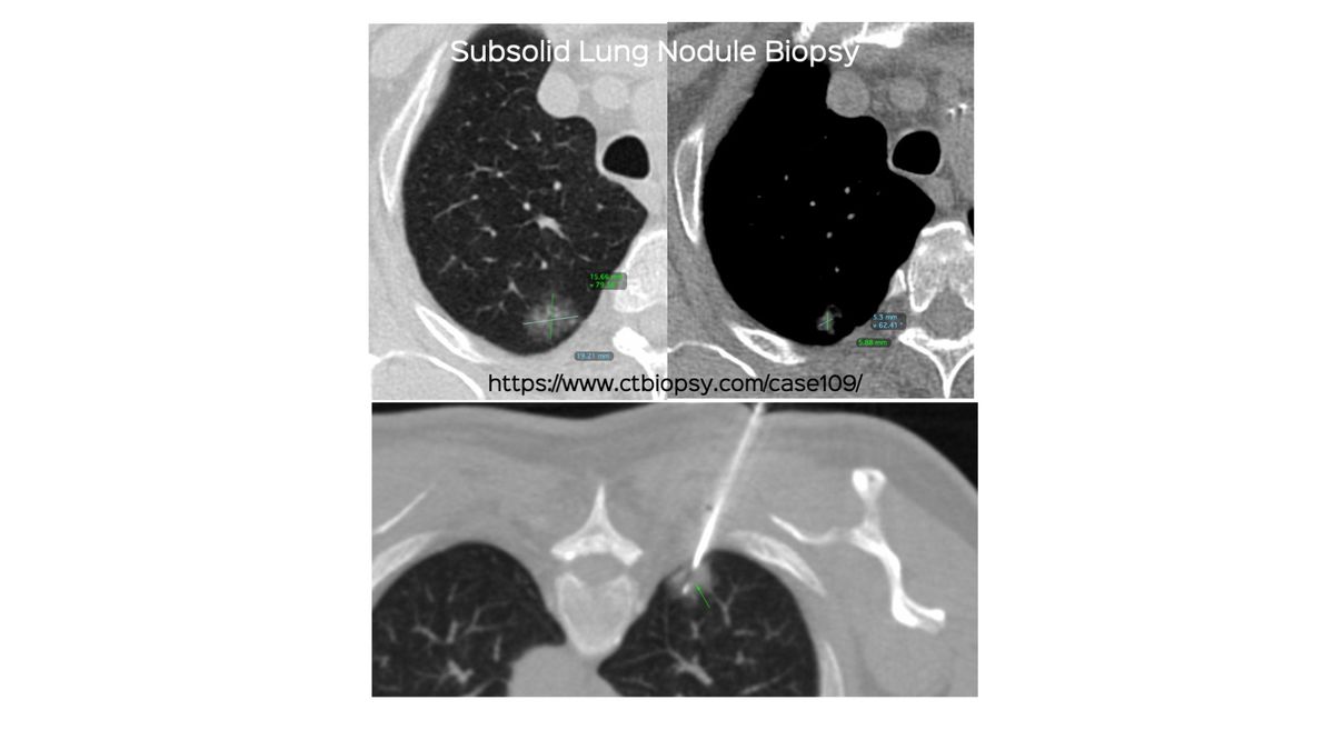 Case 109 Subsolid Lung Nodule Biopsy