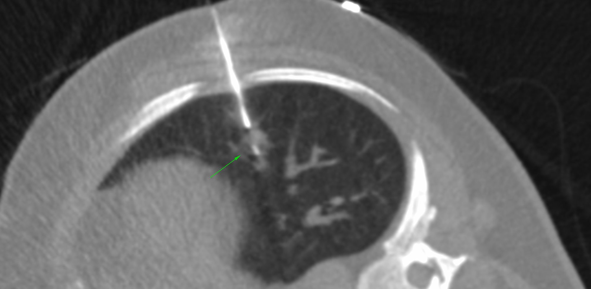 7-8-mm-lung-nodule-biopsy