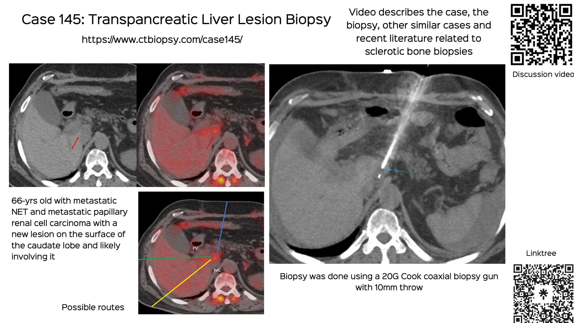 Case 145: Transpancreatic Liver Lesion Biopsy