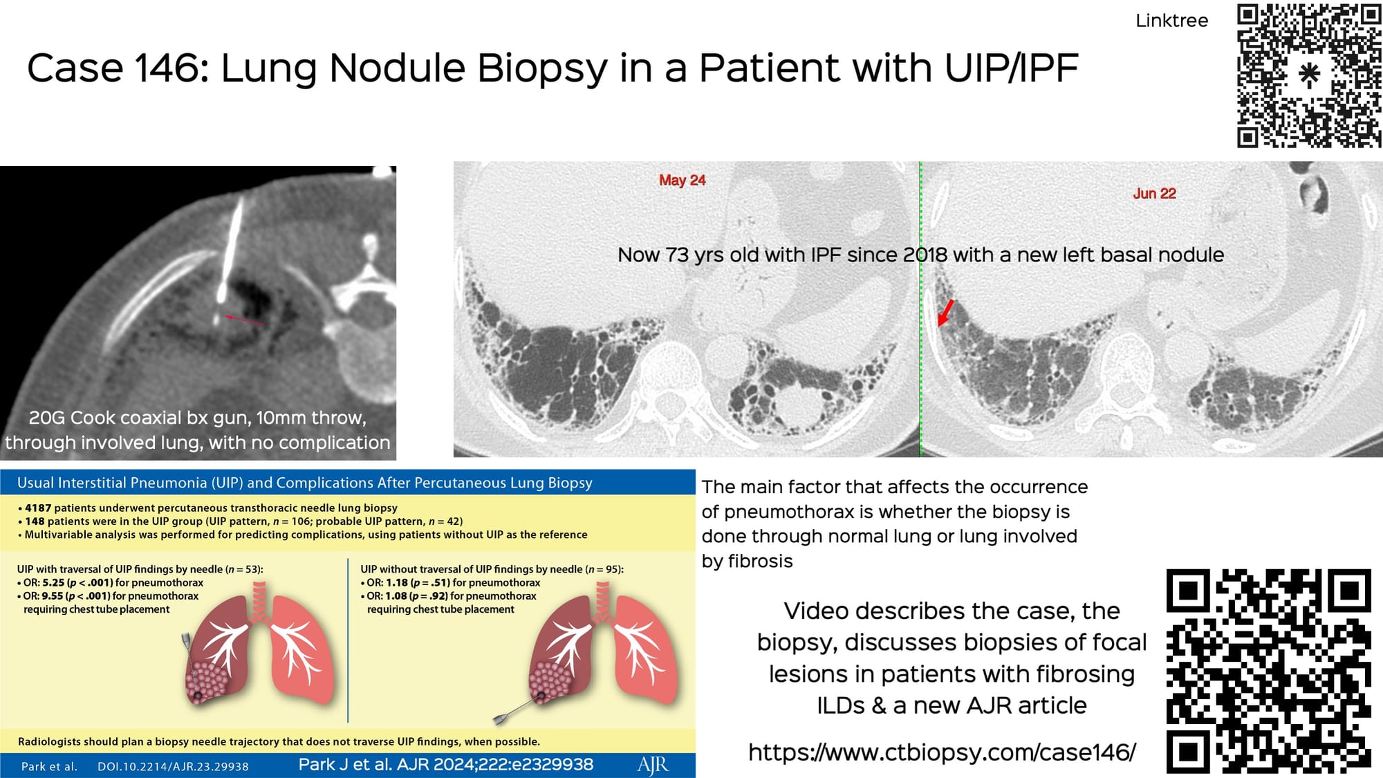 Case 146: Lung Nodule Biopsy in a Patient with UIP/IPF