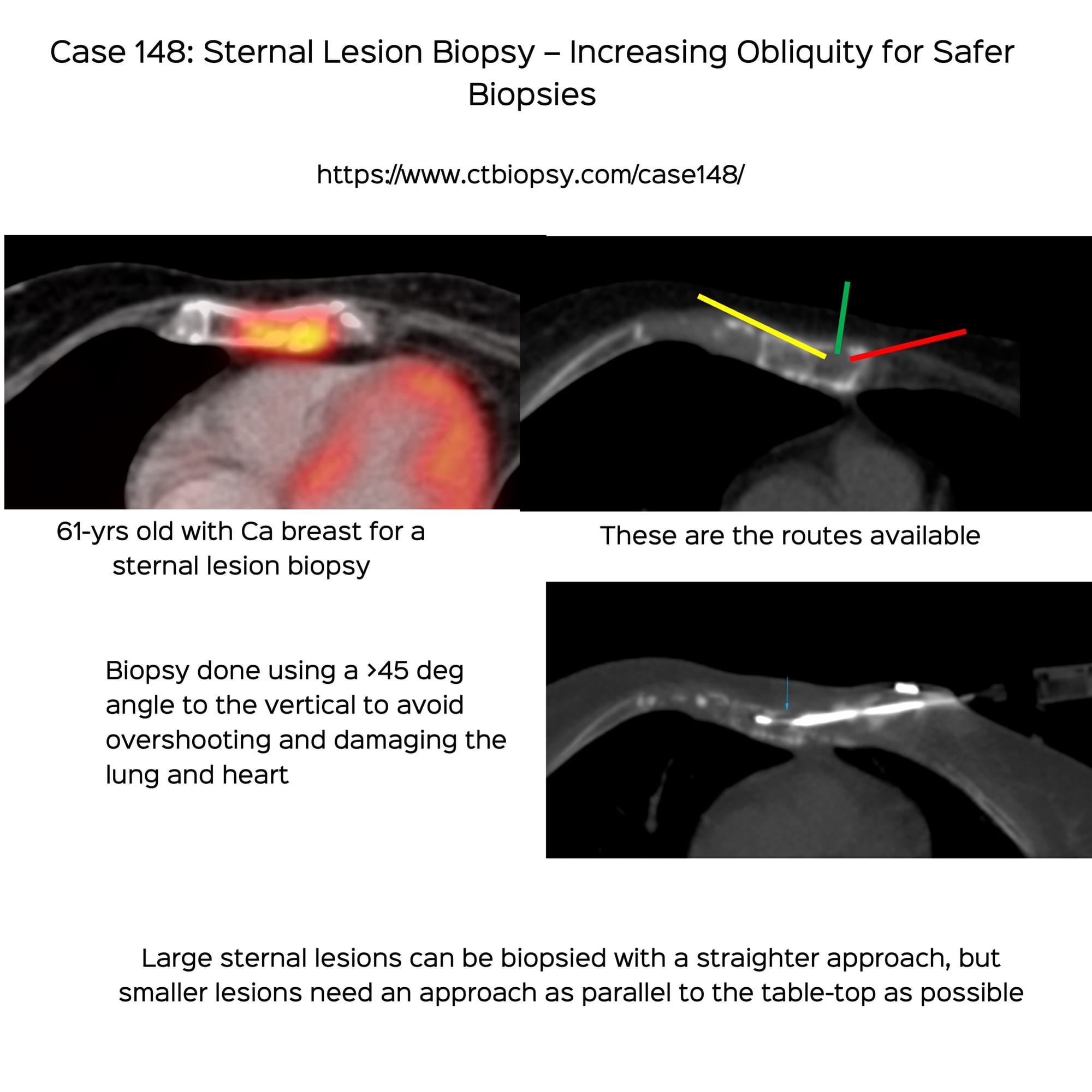 Case 148: Sternal Lesion Biopsy – Increasing Obliquity for Safer Biopsies