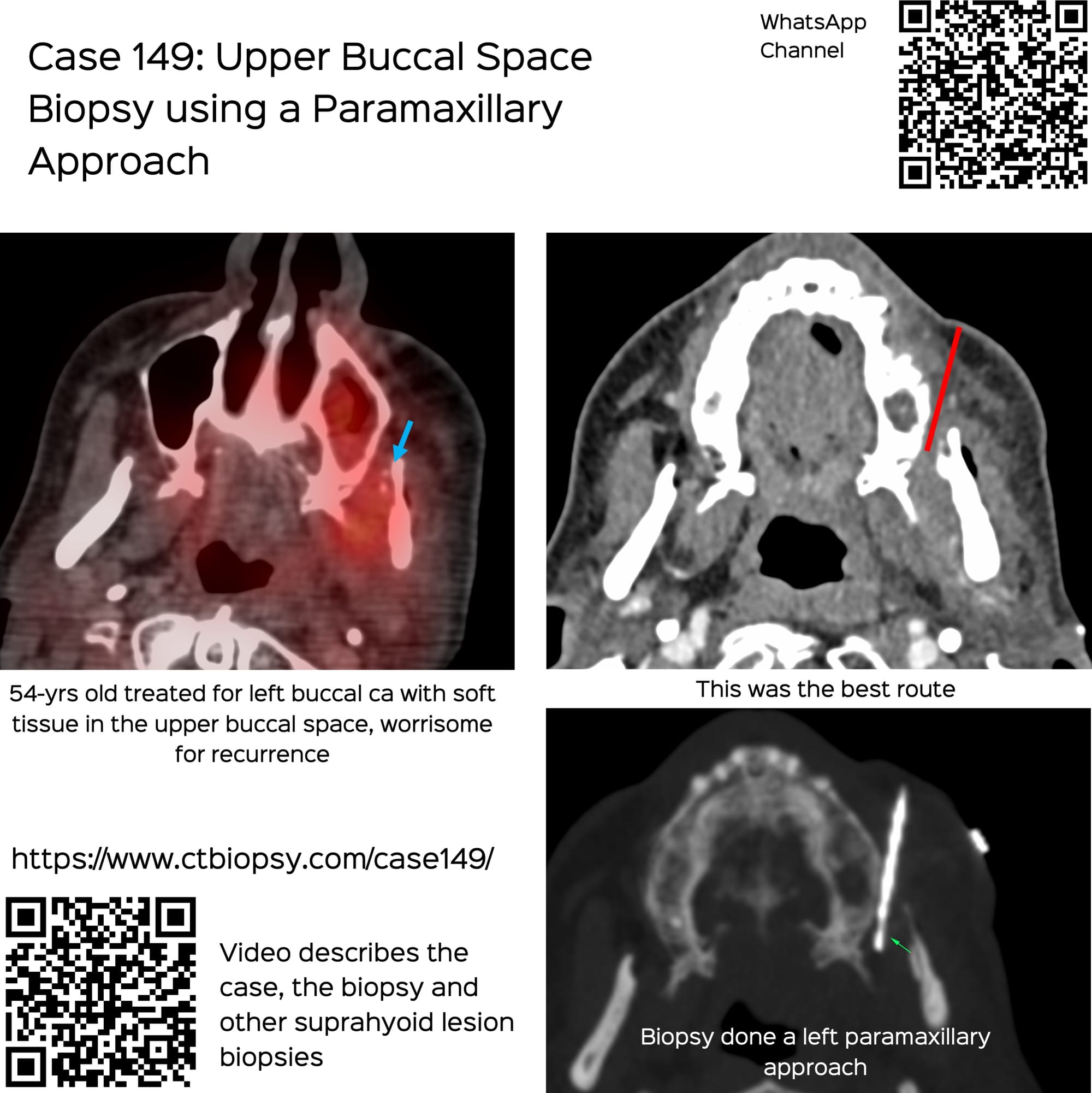 Case 149: Upper Buccal Space Biopsy with a Paramaxillary Approach