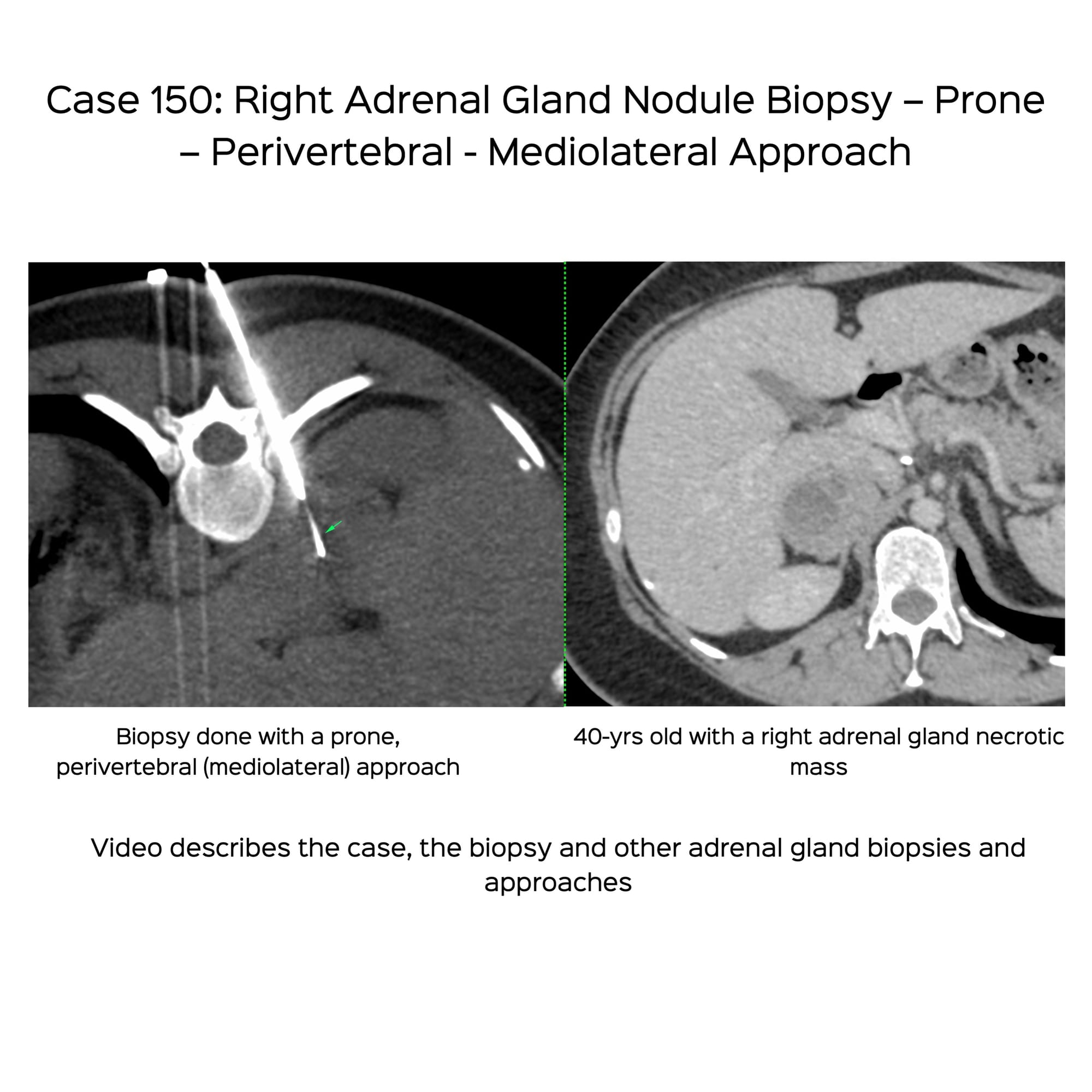 Case 150: Right Adrenal Gland Biopsy - Prone - Perivertebral - Mediolateral - Approach