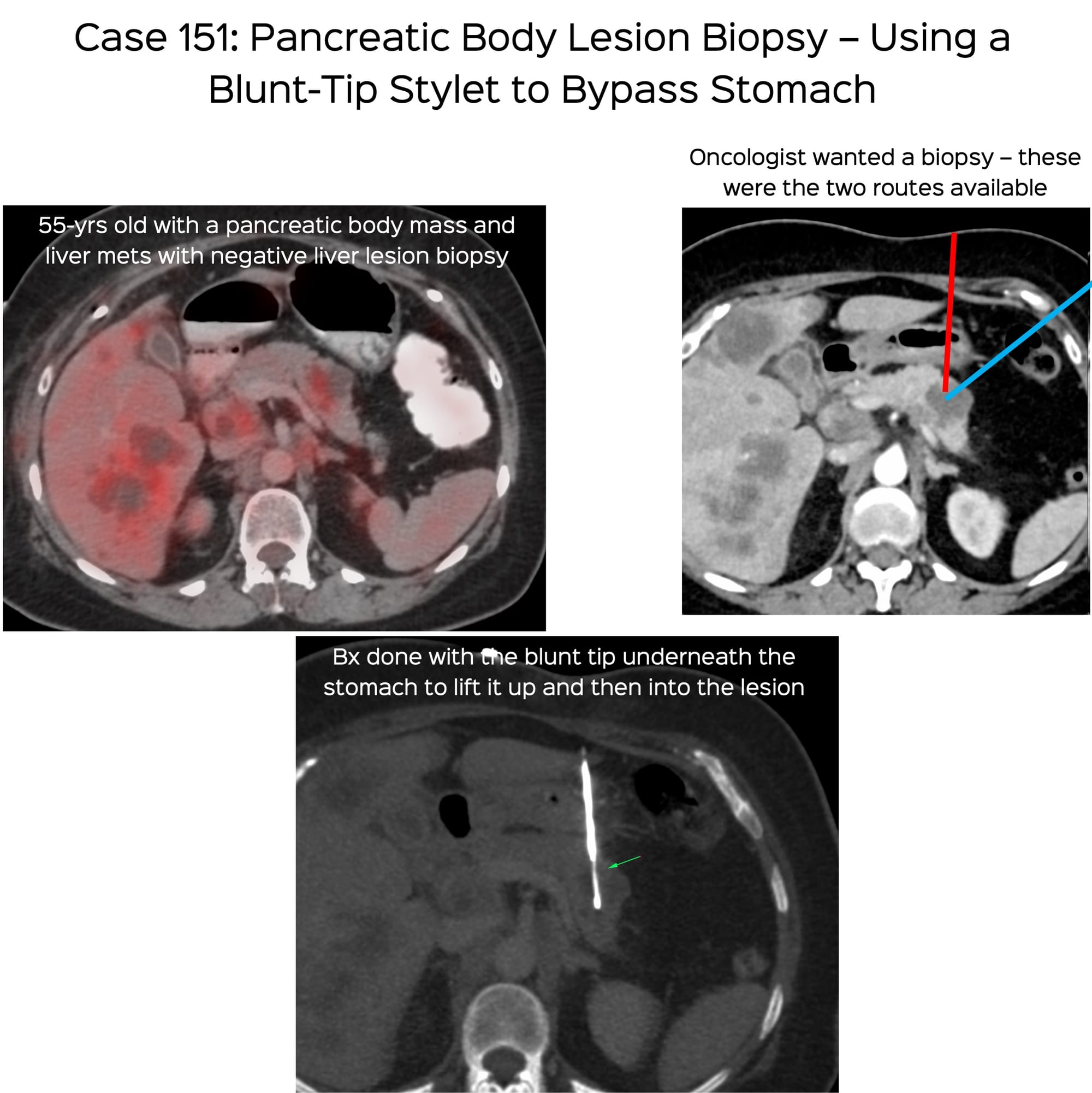 Case 151: Pancreatic Body Lesion Biopsy – Using a Blunt-Tip Stylet to Bypass Stomach