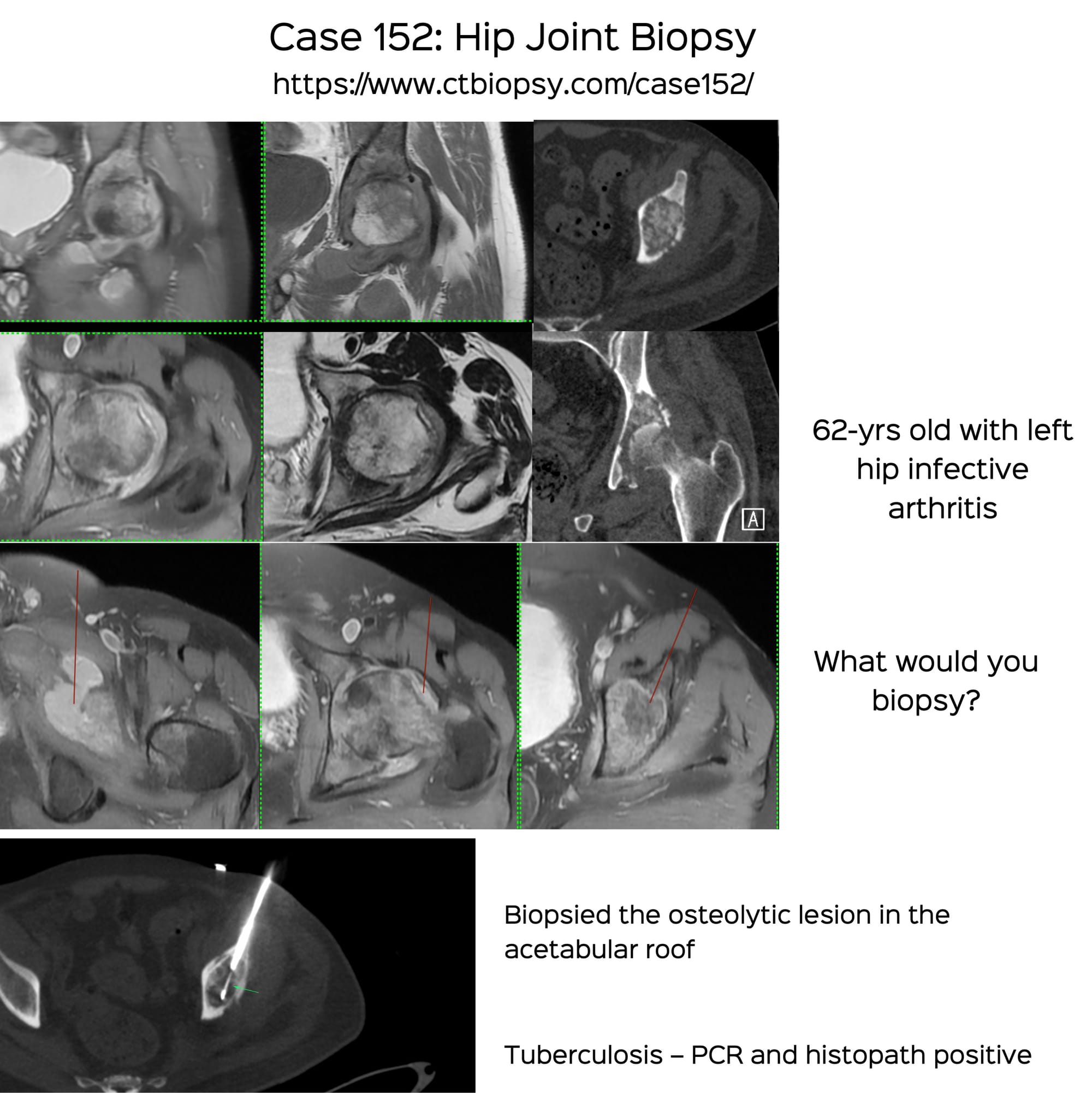 Case 152: Hip Joint Biopsy