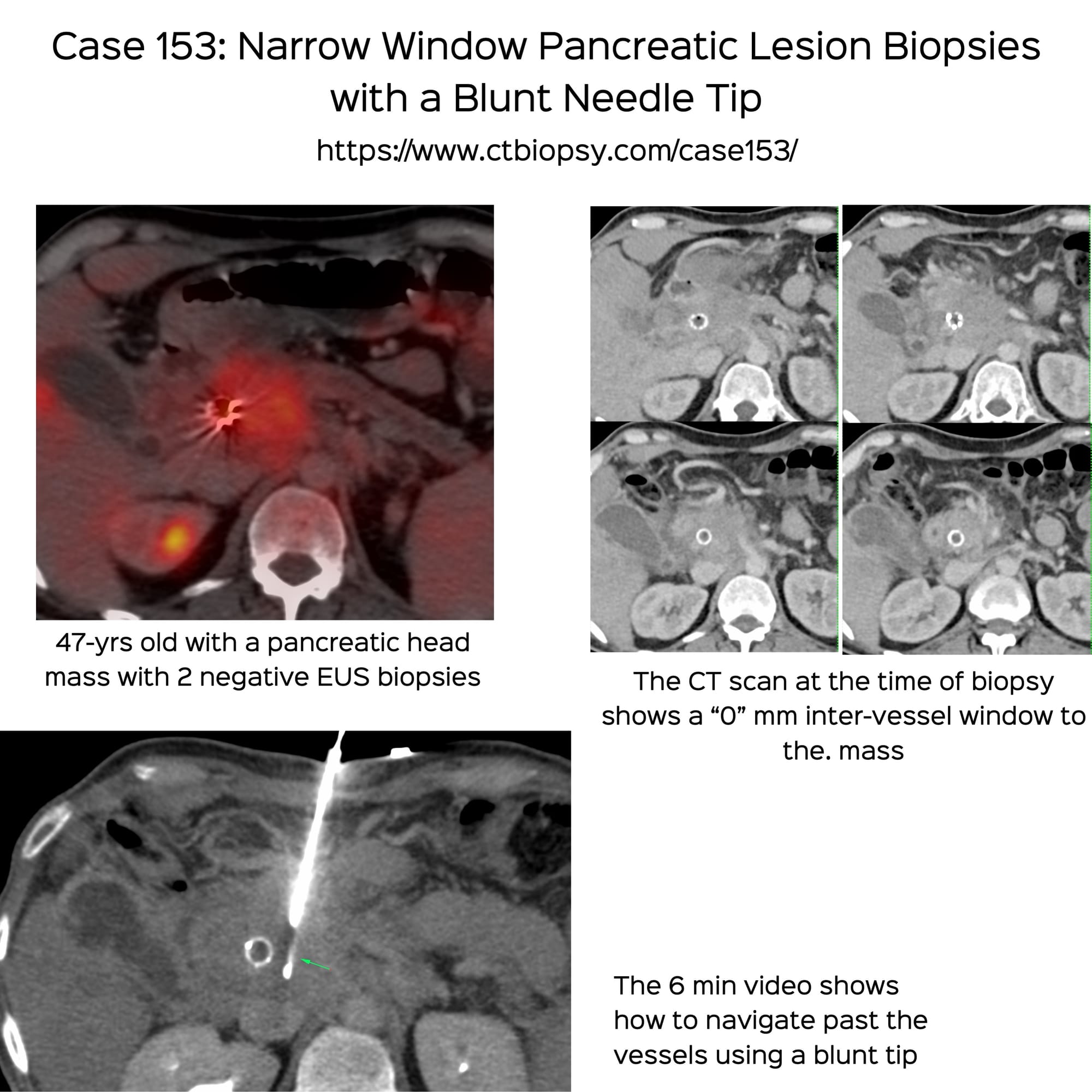 Case 153: Narrow Window Pancreatic Lesion Biopsies with a Blunt Needle Tip