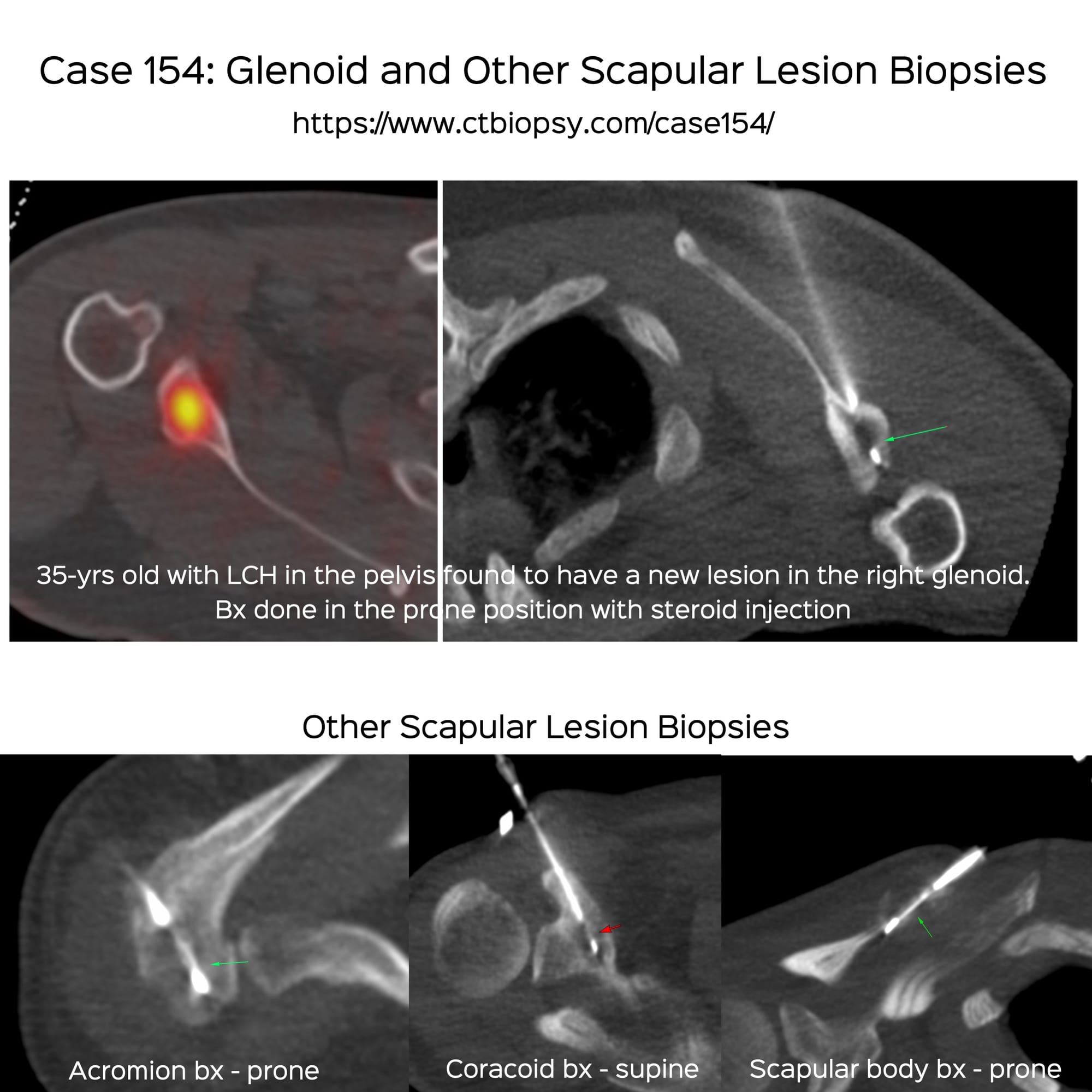 Case 154: Glenoid and Other Scapular Lesion Biopsies