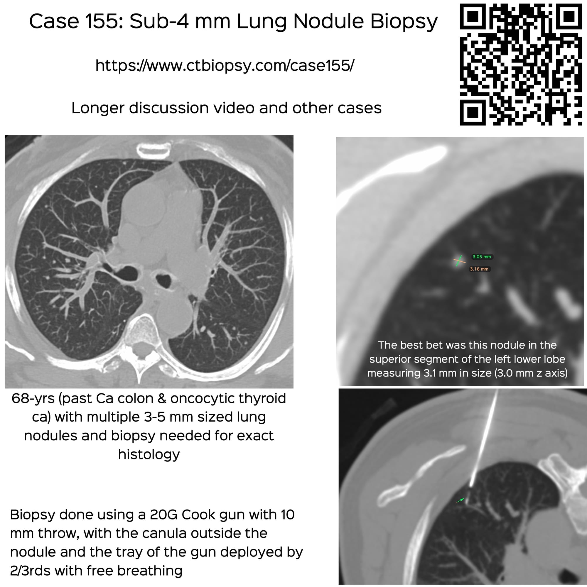 Case 155: Sub-4 mm Lung Nodule Biopsy