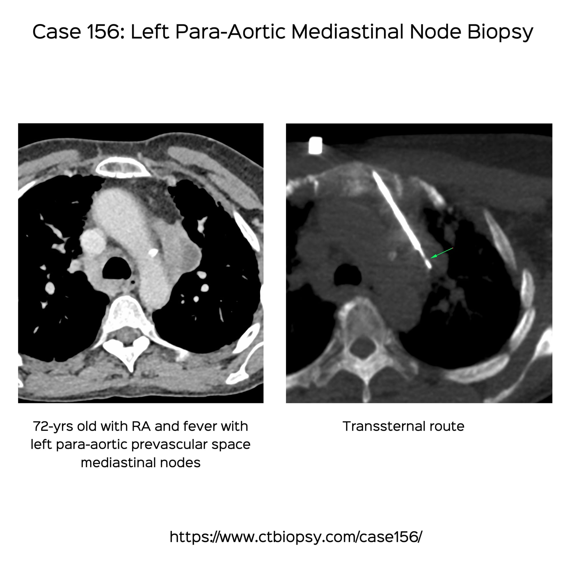 Case 156: Left Para-Aortic Mediastinal Node Biopsy