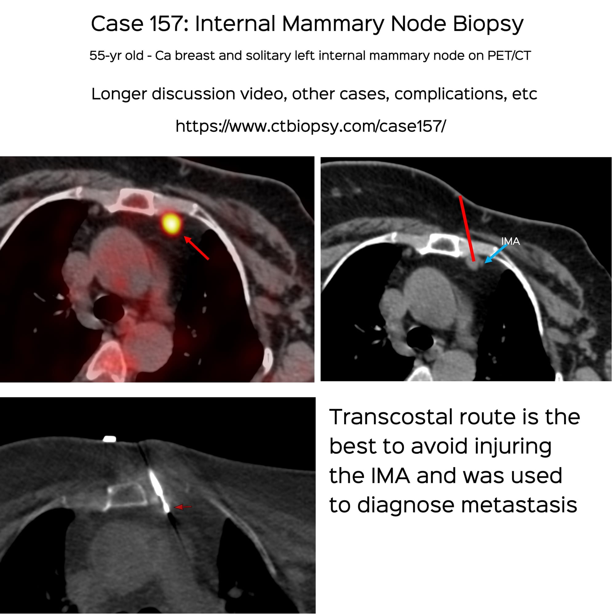 Case 157: Internal Mammary Node Biopsy