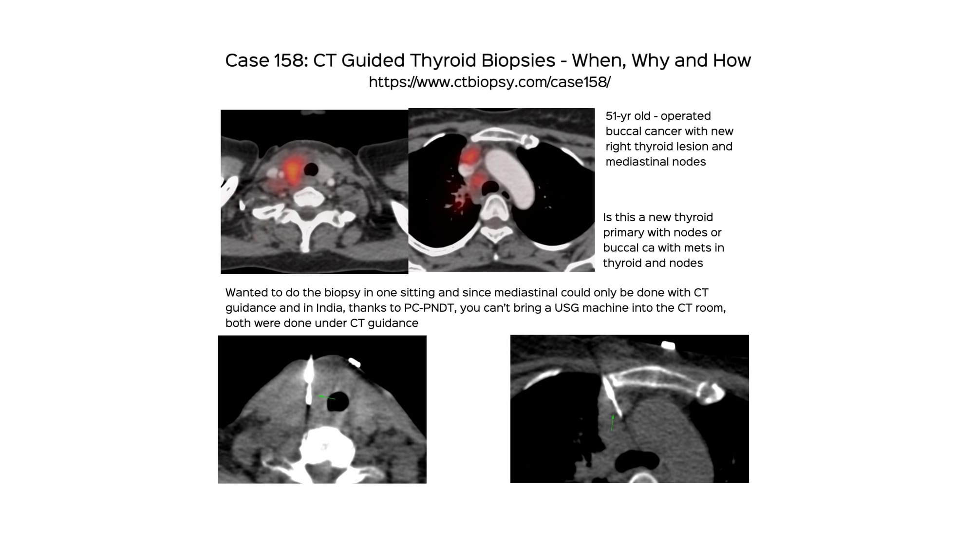 Case 158: CT Guided Thyroid Biopsy - When, Why and How!