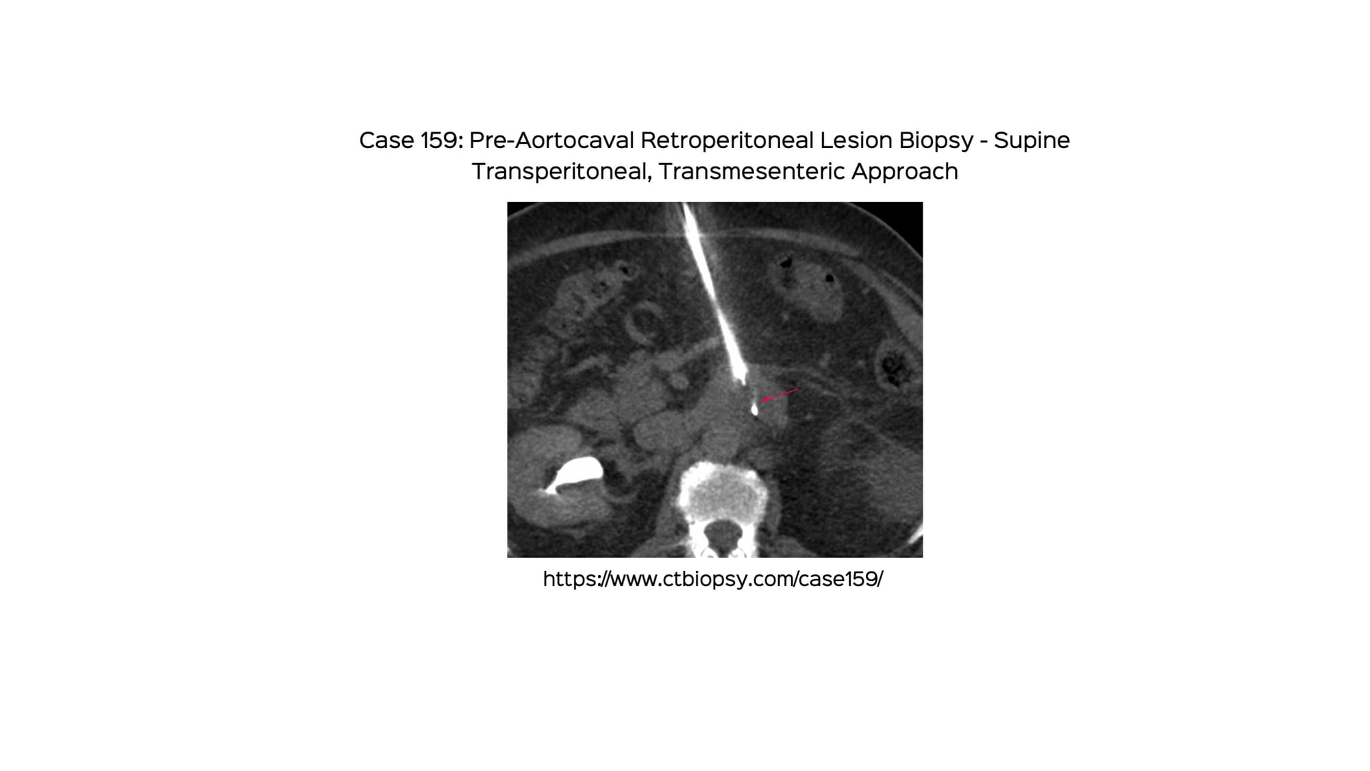 Case 159: Pre-Aortocaval Retroperitoneal Lesion Biopsy - Supine Transperitoneal, Transmesenteric Approach