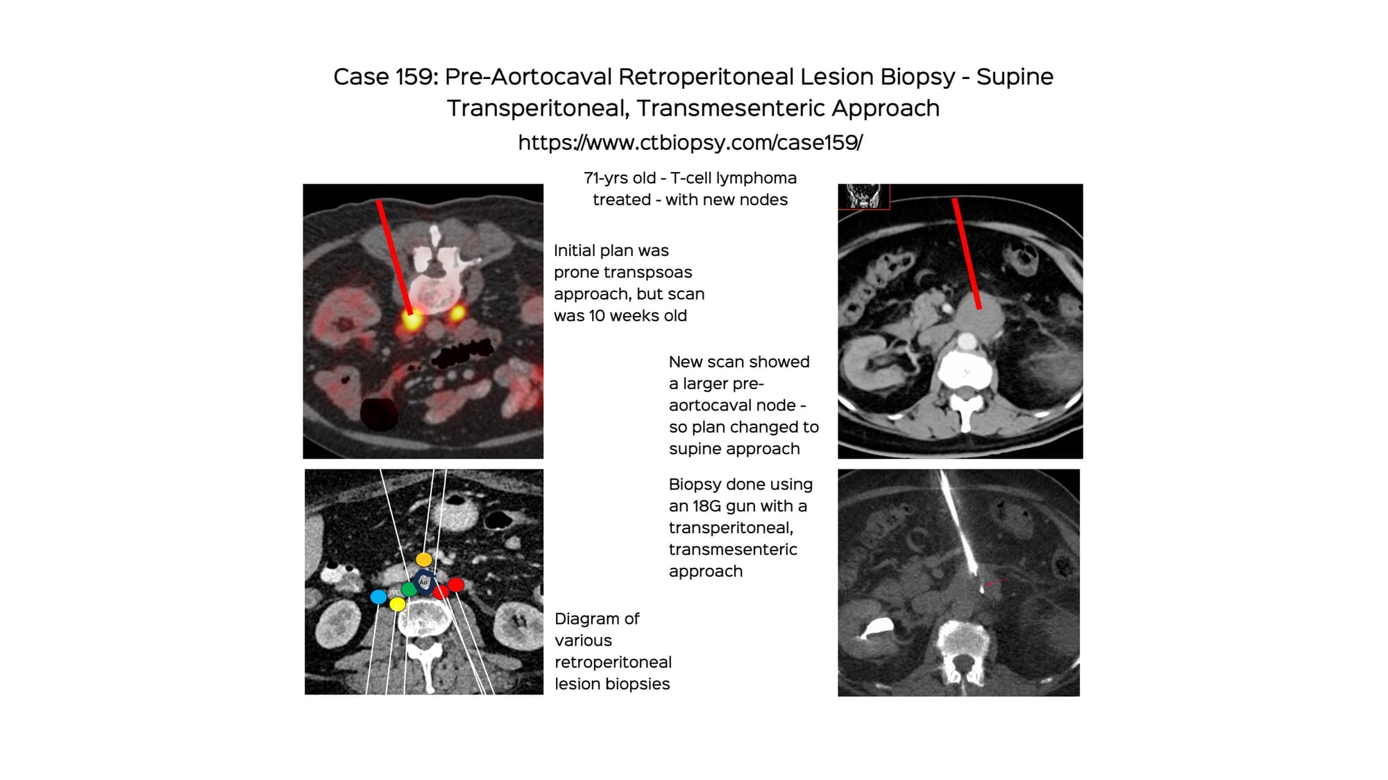 Case 159: Pre-Aortocaval Retroperitoneal Lesion Biopsy - Supine Transperitoneal, Transmesenteric Approach