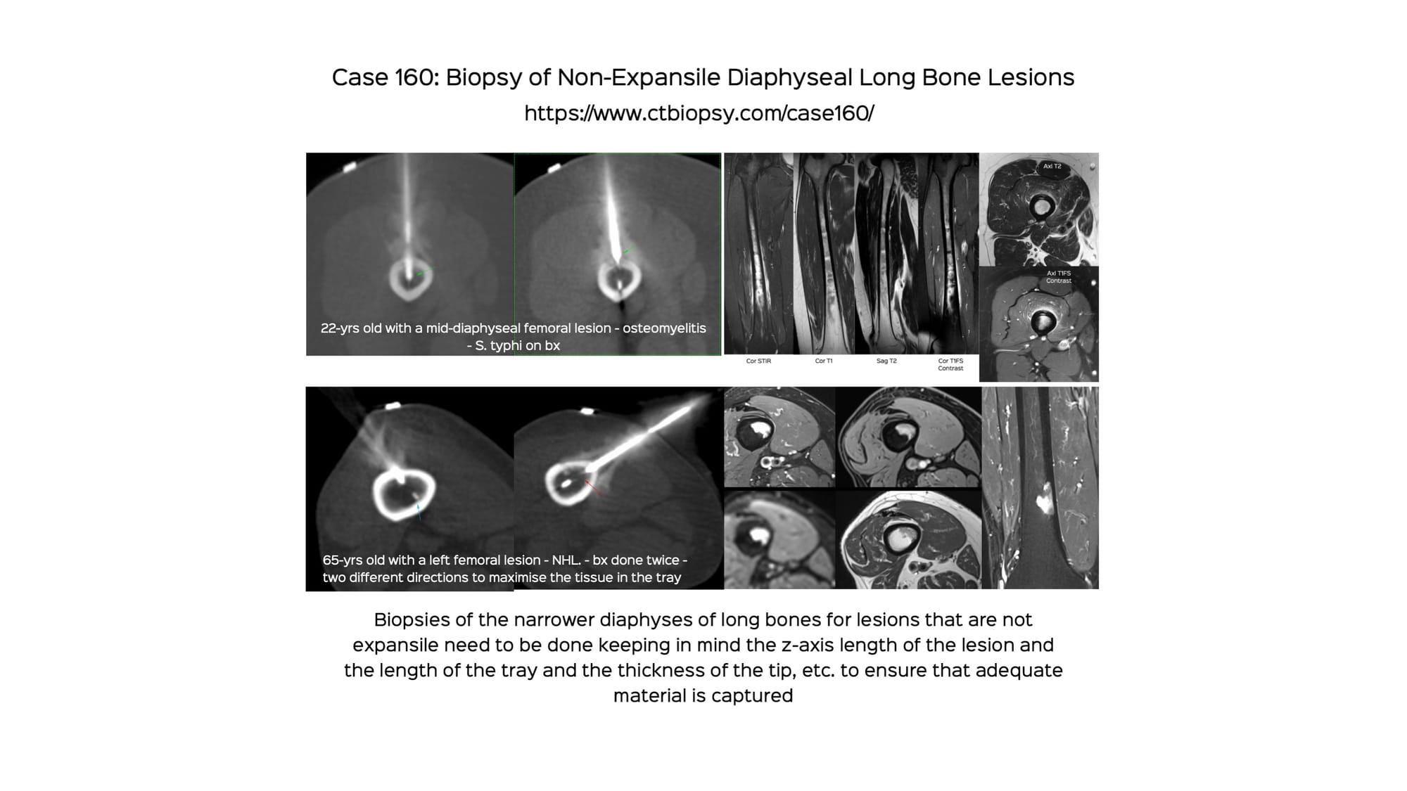 Case 160: Biopsy of Non-Expansile Diaphyseal Long Bone Lesions