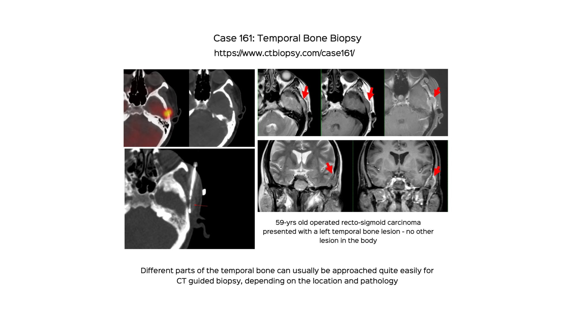 Case 161: Temporal Bone Biopsy