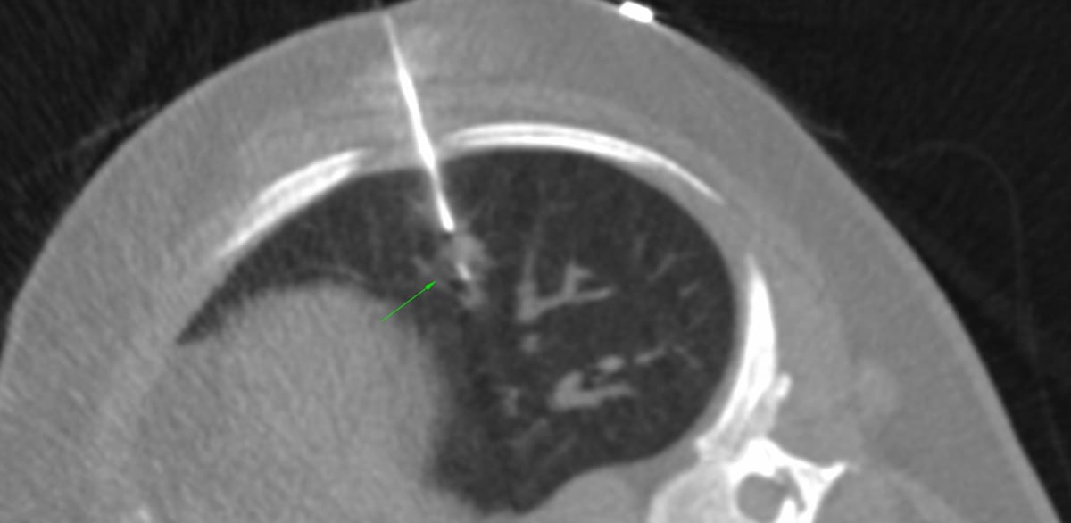 7.8 mm lung nodule biopsy