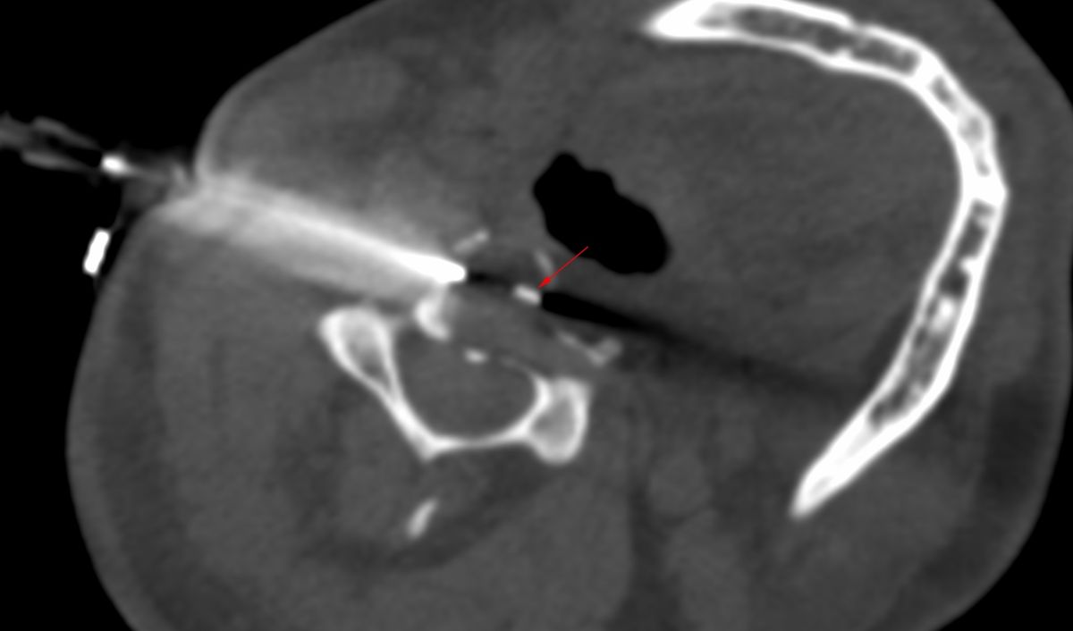 Case 54 C3 Vertebral Body Lesion Biopsy Using A Far Posterolateral Approach