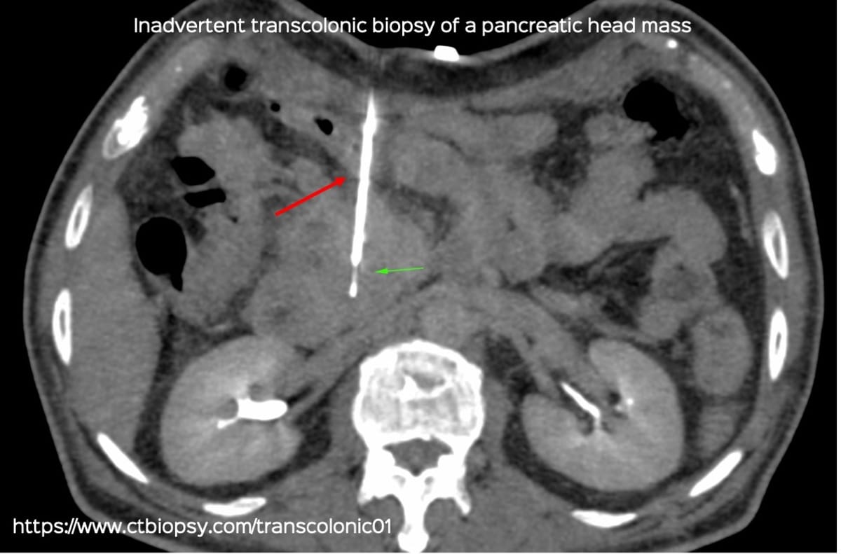 Case 79: Inadvertent Transcolonic Biopsy of a Pancreatic Head Mass