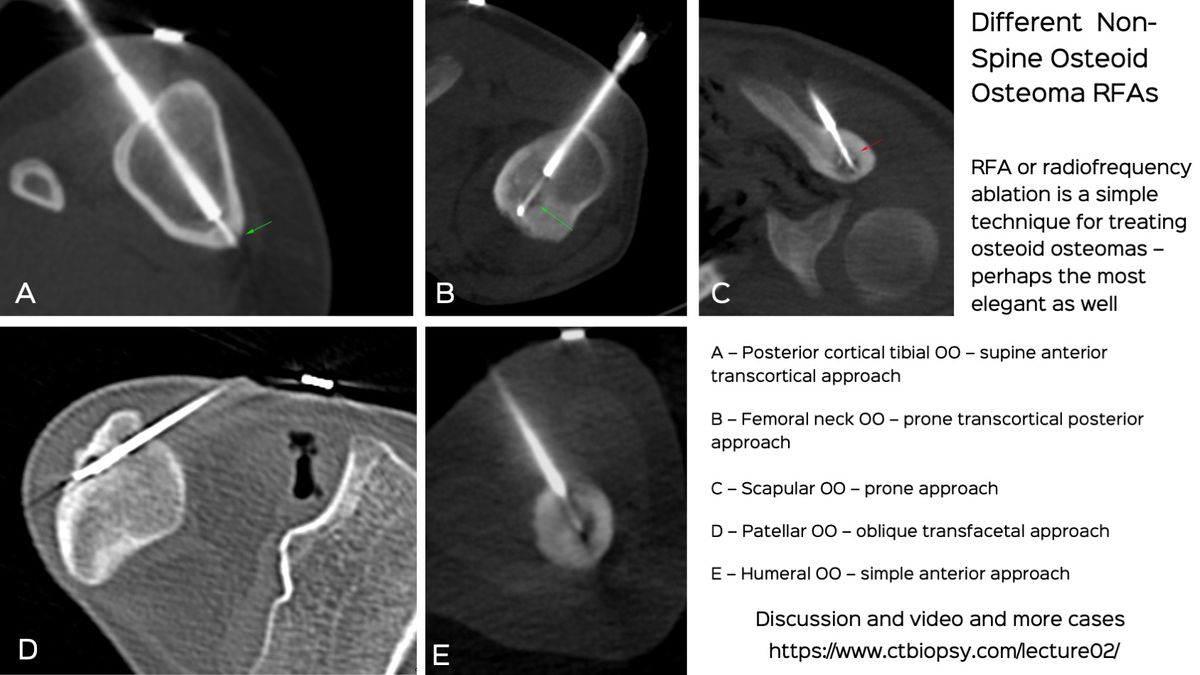 Lecture: Osteoid Osteomas - Treatment Methods Focussing on ...