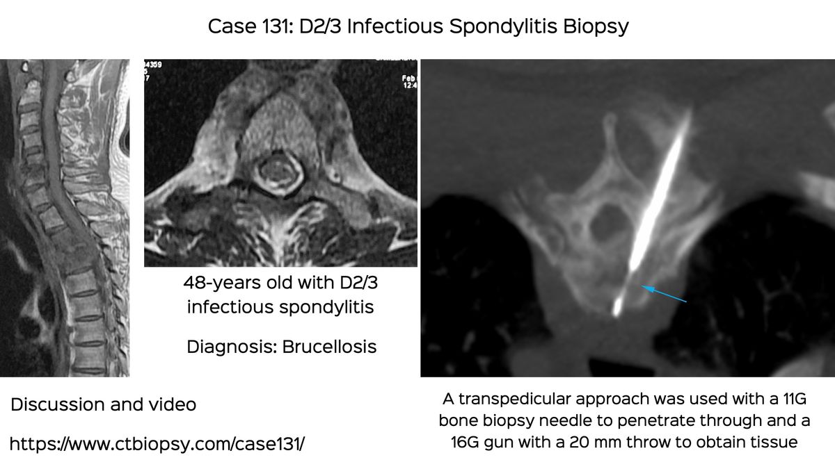 case-131-transpedicular-dorsal-spine-biopsy-and-a-surprise-diagnosis